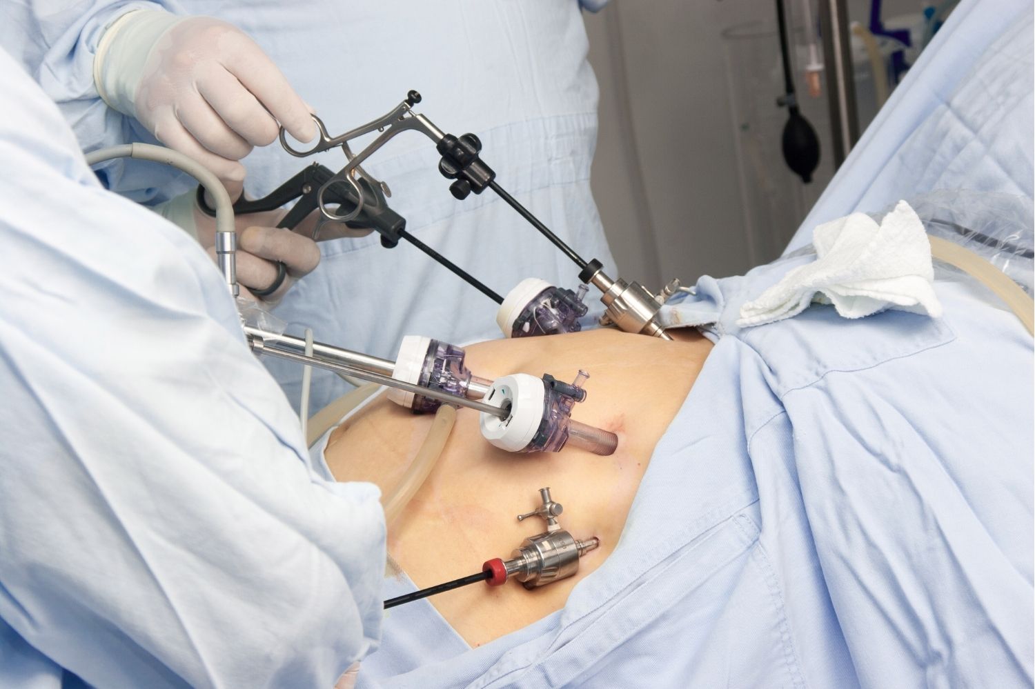 Sleeve Gastrectomie