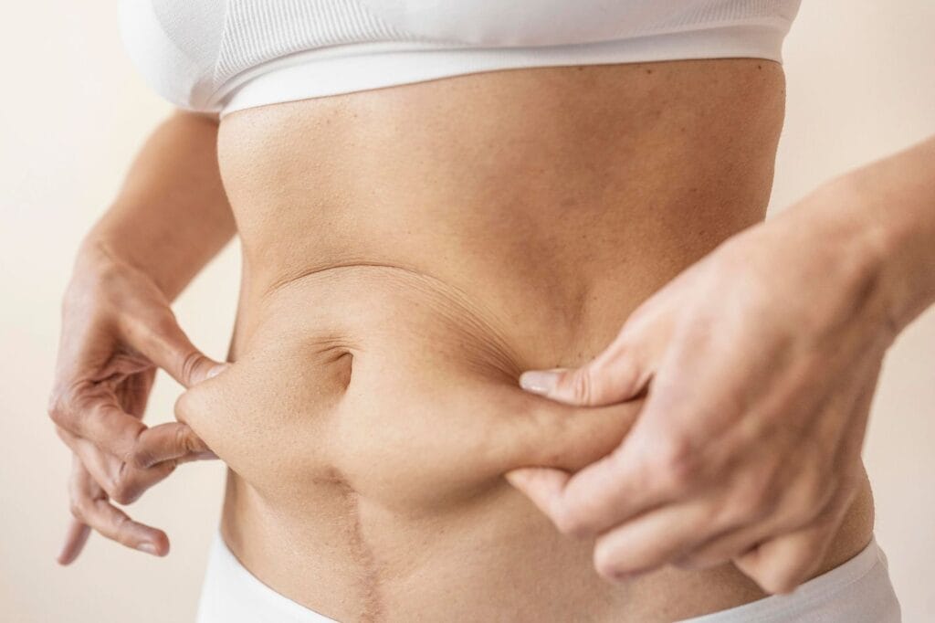 Abdominoplastie