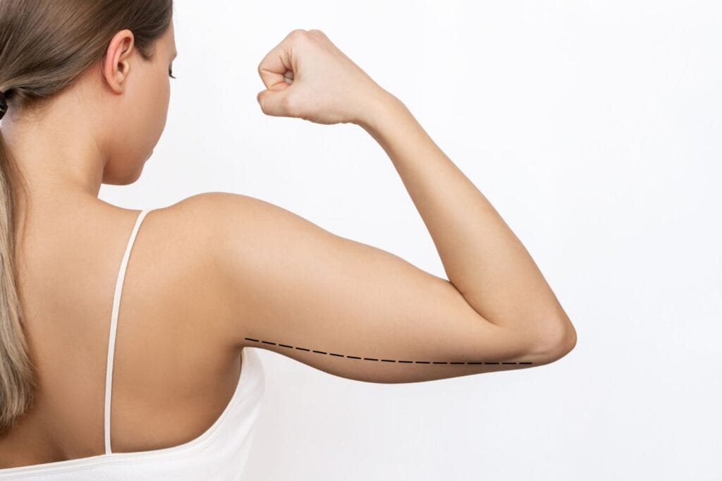 Lifting des Bras