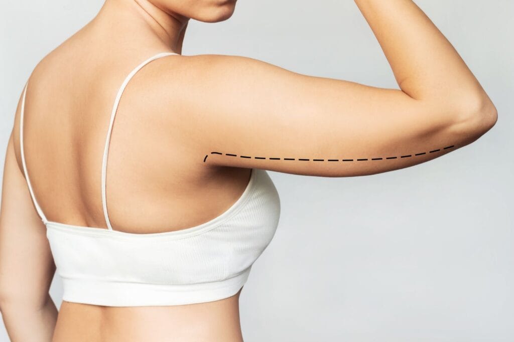 Lifting des Bras