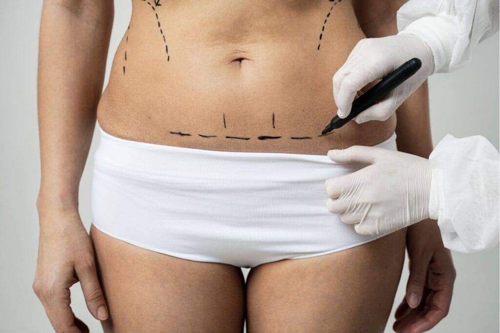 Liposuccion
